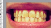 teeth-whitening